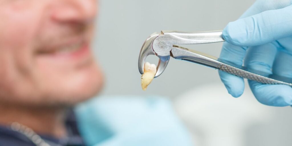 Tooth Extraction