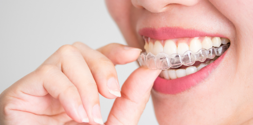 Invisalign: Frequently Asked Questions